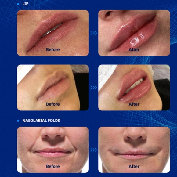 Tesoro Deep Dermal Filler for lips. Hyaluronic Acid. - Picture 7 of 7